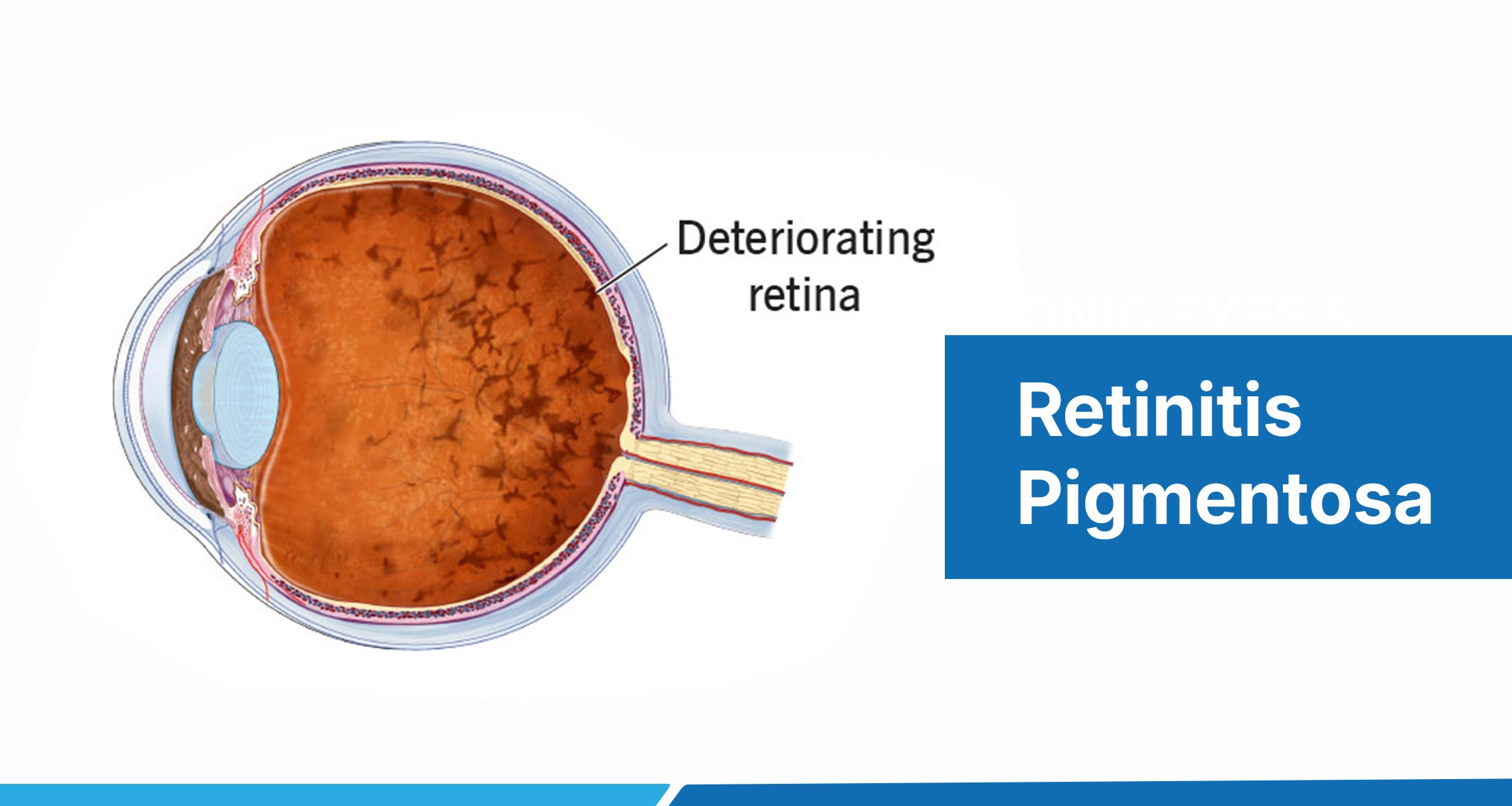 Understanding Retinitis Pigmentosa: Symptoms, Causes, Diagnosis, and Treatment | Drishti Eye Care Team
