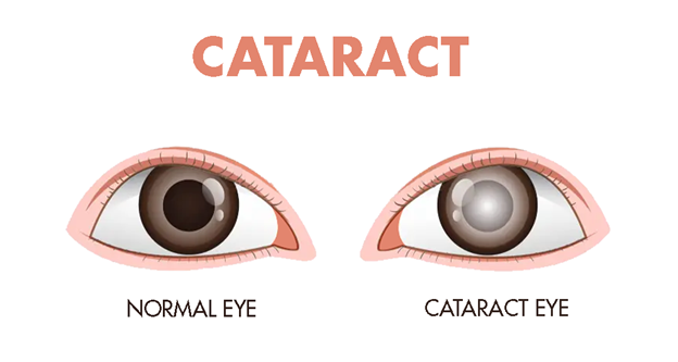 Cataracts: Understanding Causes, Symptoms, and Treatment Options | Drishti Eye Care System