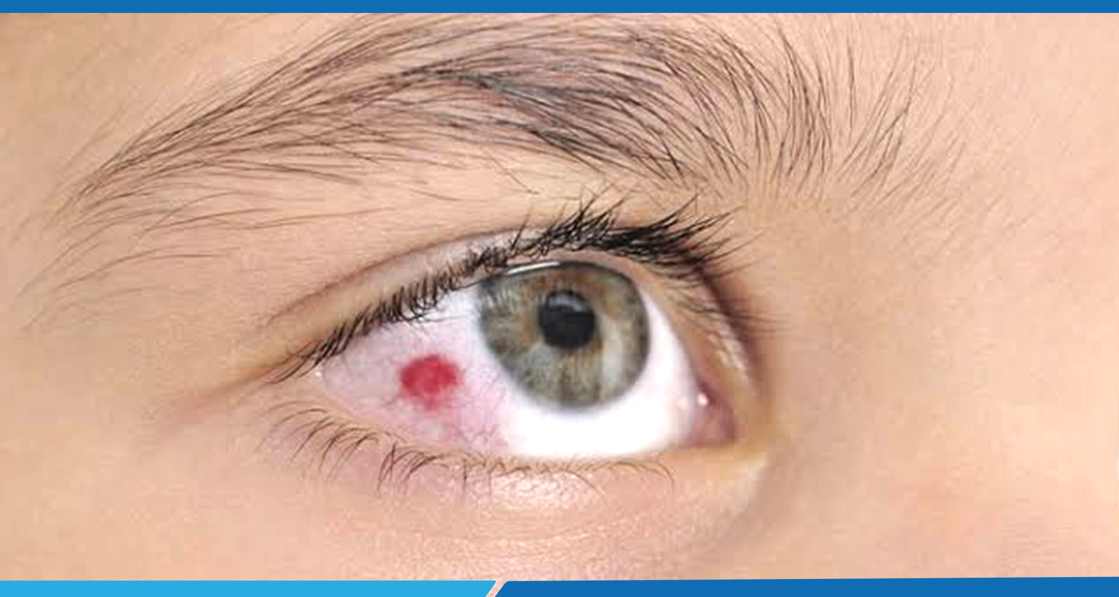 First Aid for Eye Injuries: A Comprehensive Guide