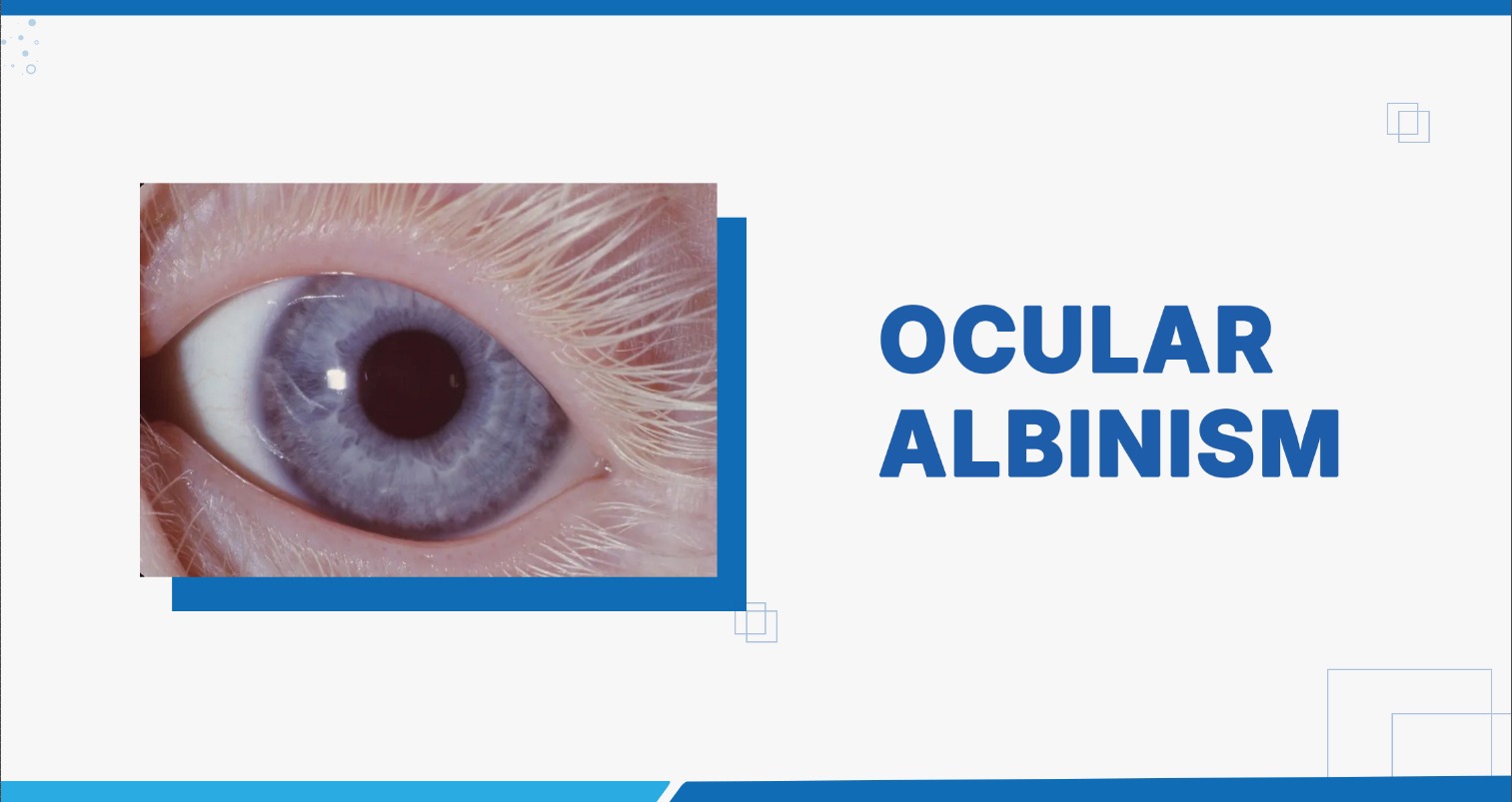 Ocular Albinism: A Comprehensive Guide