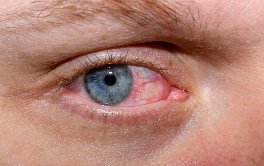 Understanding and Managing Dry Eye Syndrome