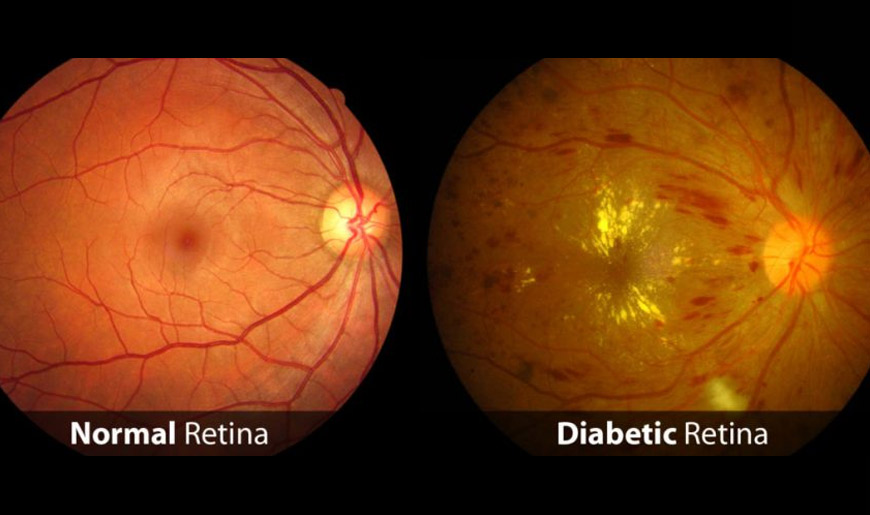 Understanding Diabetic Retinopathy: Causes, Symptoms, and Treatment Options  | Drishti Eye Care System