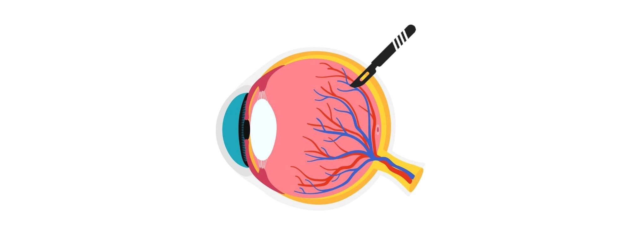 Understanding Retina Surgery: Procedures, Types, and Recovery